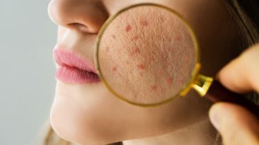 DERMATOLOGY, STD & LEPROSY Subharti Medical College